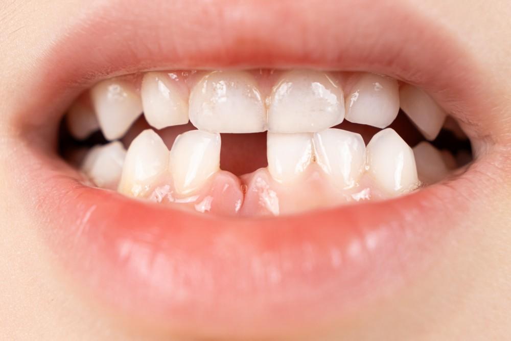 Follow These Steps to Save Your Knocked Out Tooth