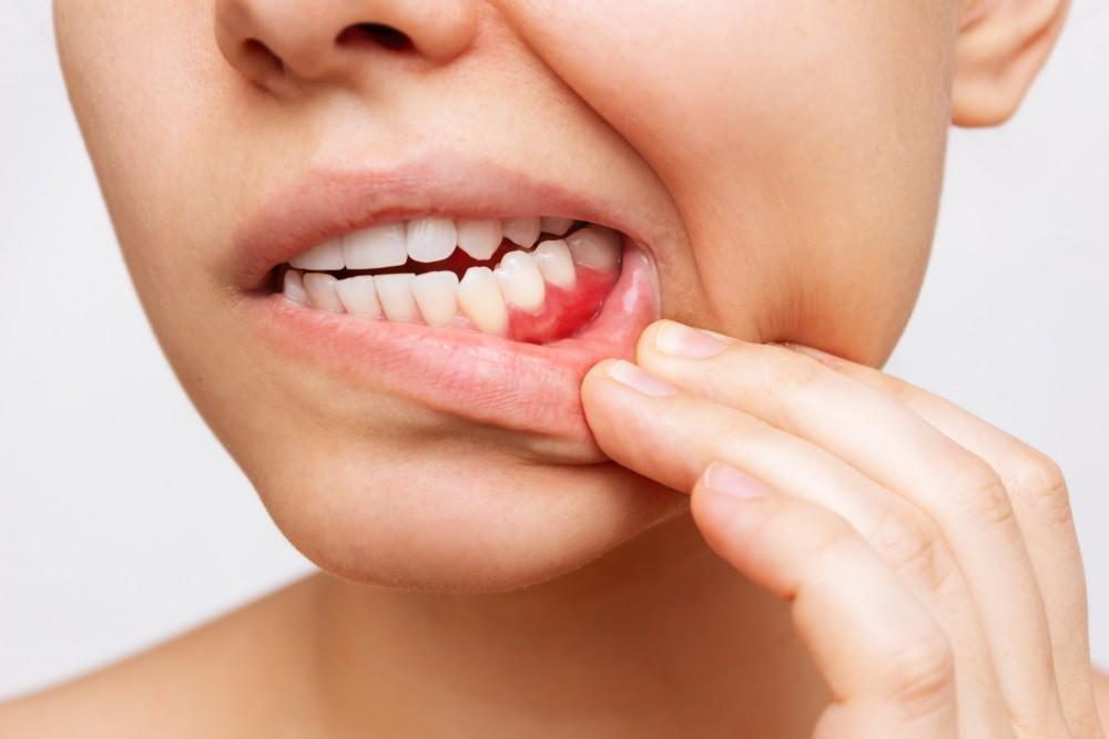 Laser Therapy for Gum Disease: No Pain, All Gain