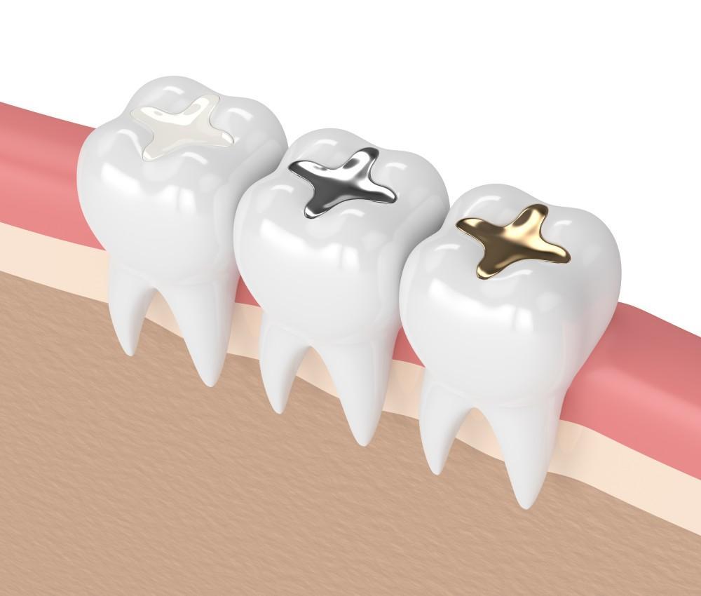 Why Are Mercury Fillings Considered Unsafe?