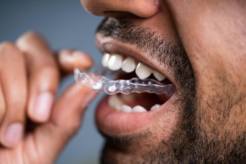 5 Benefits of Invisalign®